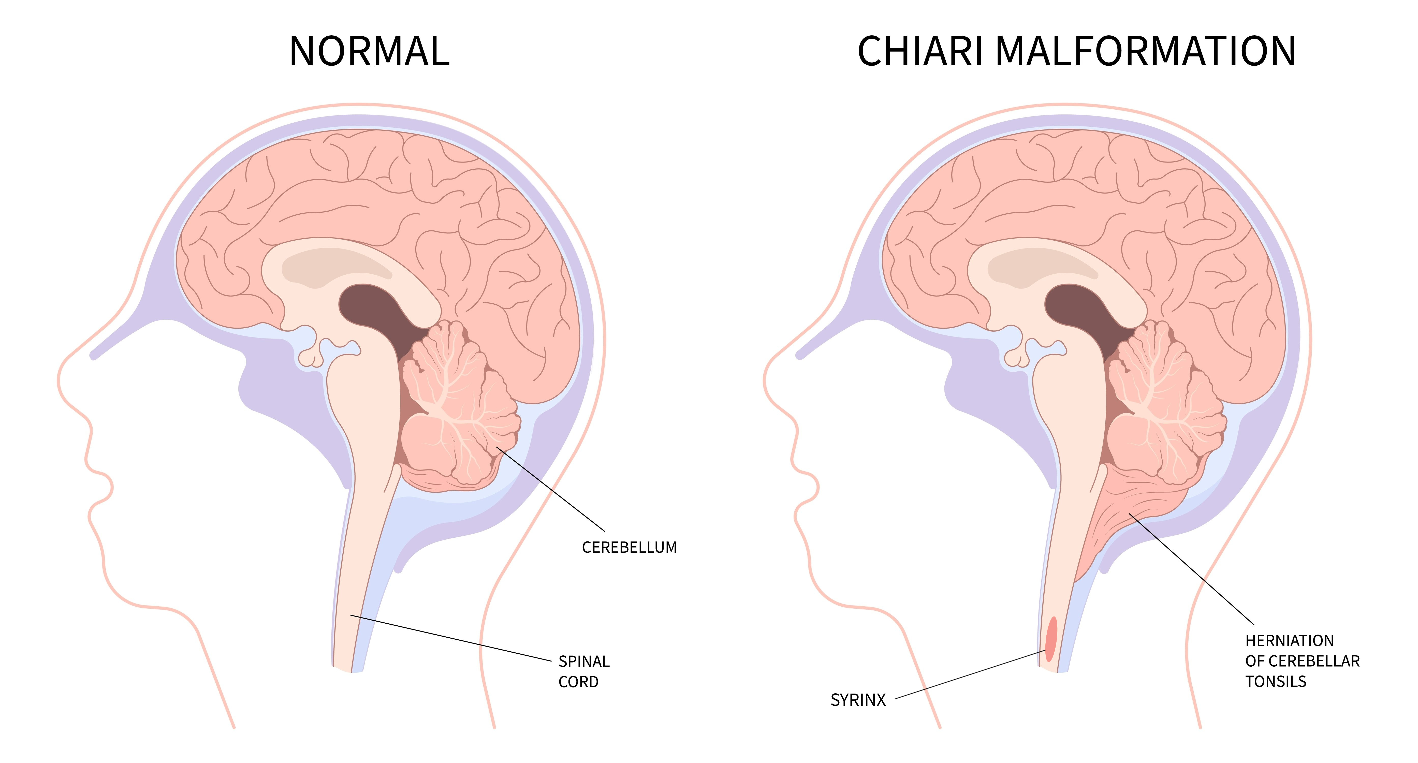 Chiari Malformation